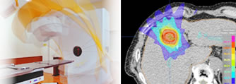 肝がんに対する放射線治療
